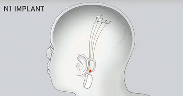 Neuralink: Khởi Đầu Cuộc Cách Mạng Cấy Chip Não