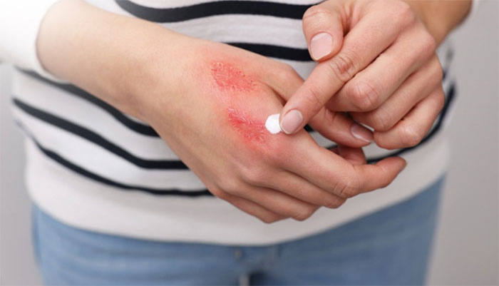 Sử dụng kẽm oxit để giảm triệu chứng vết thương