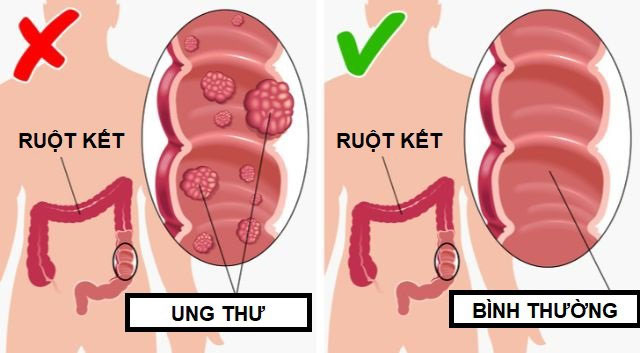 loi-ich-khi-an-dua-chuot-moi-ngay-2 Giảm nguy cơ mắc ung thư