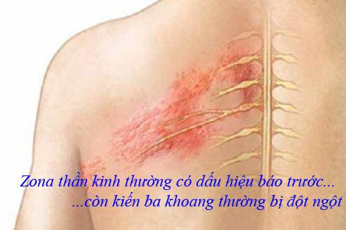 Vết thương do kiến ba khoang thường xuất hiện đột ngột