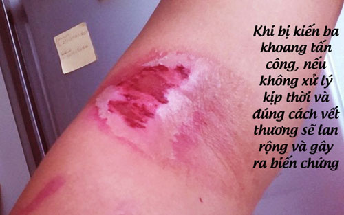 Hậu quả khi không xử lý vết thương do kiến ba khoang kịp thời