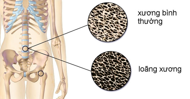 Chăm Sóc Sức Khỏe Xương: 4 loại thực phẩm Tàn Phá Canxi Cần Tránh